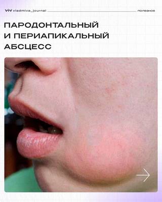 Пародонтальный vs периапикальный абсцесс: таблица различий.